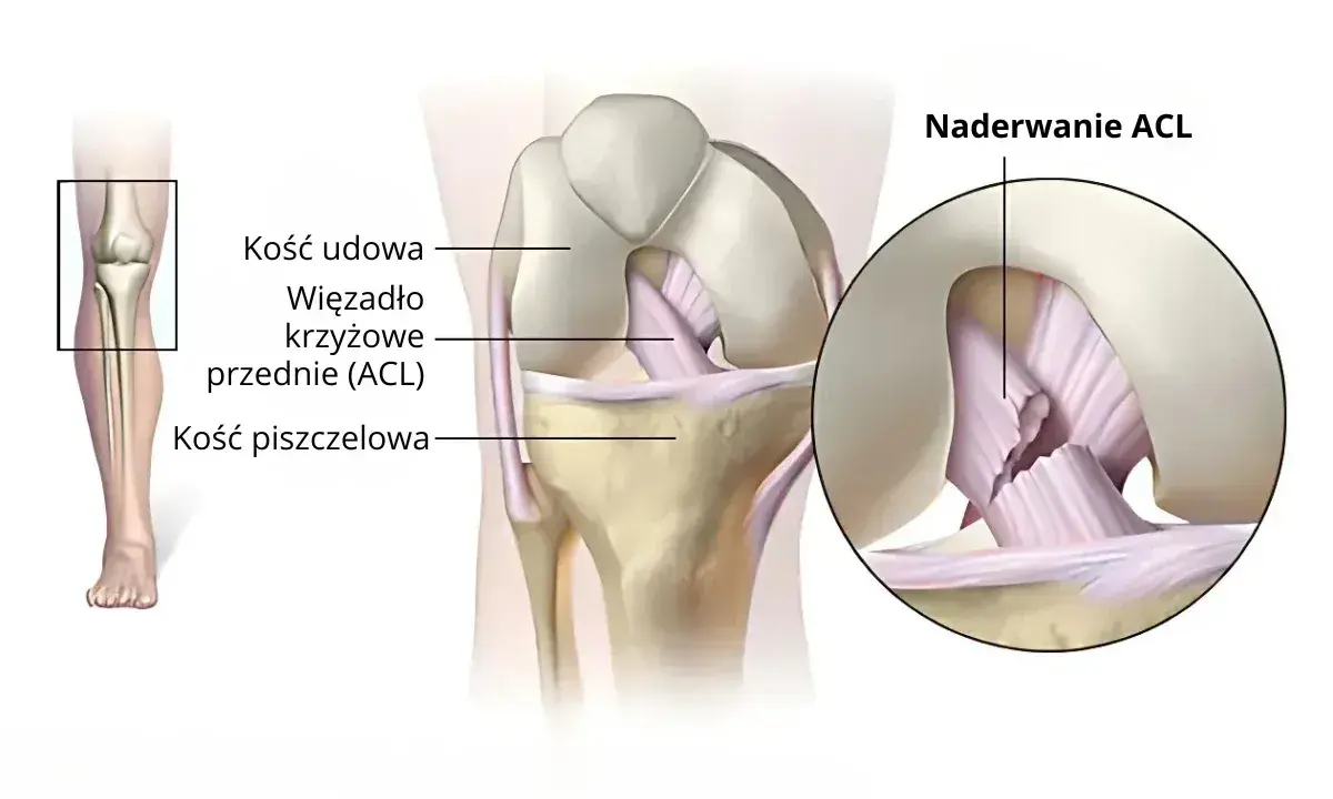 Naderwane więzadło krzyżowe przednie (ACL) w kolanie. Ilustracja pokazuje anatomię stawu kolanowego i uszkodzenie ACL.