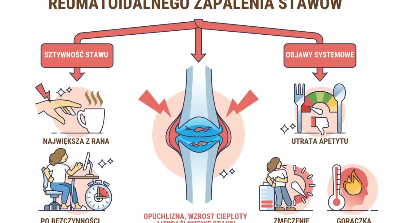 Wczesne objawy reumatoidalnego zapalenia stawów: sztywność stawu, opuchlizna, zmęczenie, gorączka, utrata apetytu.