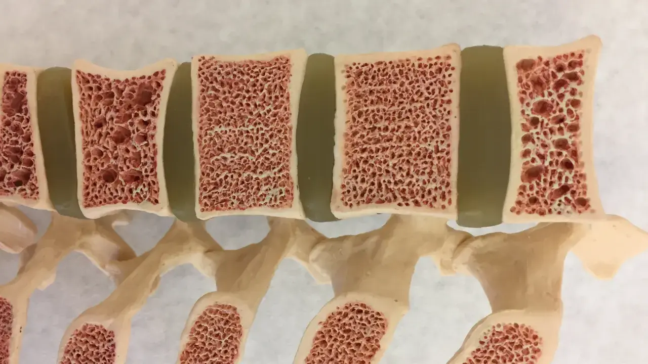 Model kręgosłupa z widocznymi przekrojami kości. Gąbczasta struktura kości sugeruje osteoporozę, czyniąc je kruchymi.