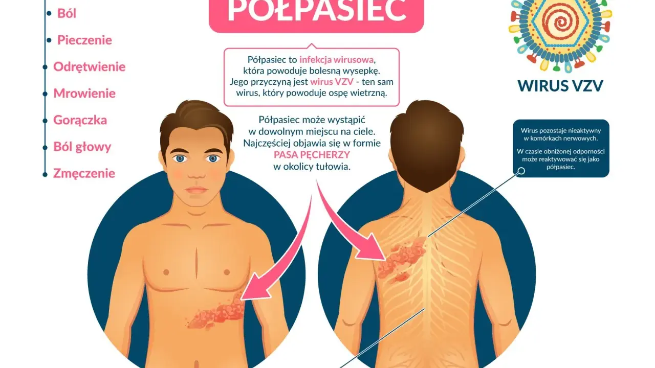 Objawy półpaśca: ból, pieczenie, gorączka. Jak złagodzić ból przy półpaścu? Infekcja wirusem VZV powoduje bolesną wysypkę.