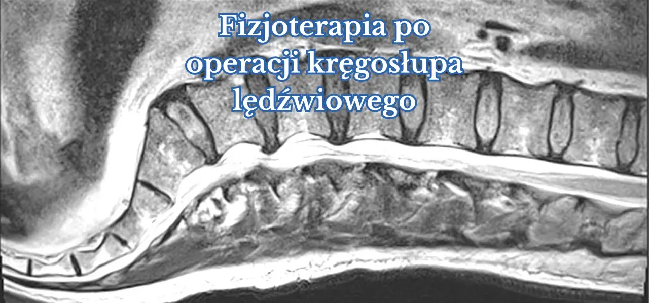 Obraz rezonansu magnetycznego kręgosłupa lędźwiowego, ilustrujący proces rehabilitacji po operacji.