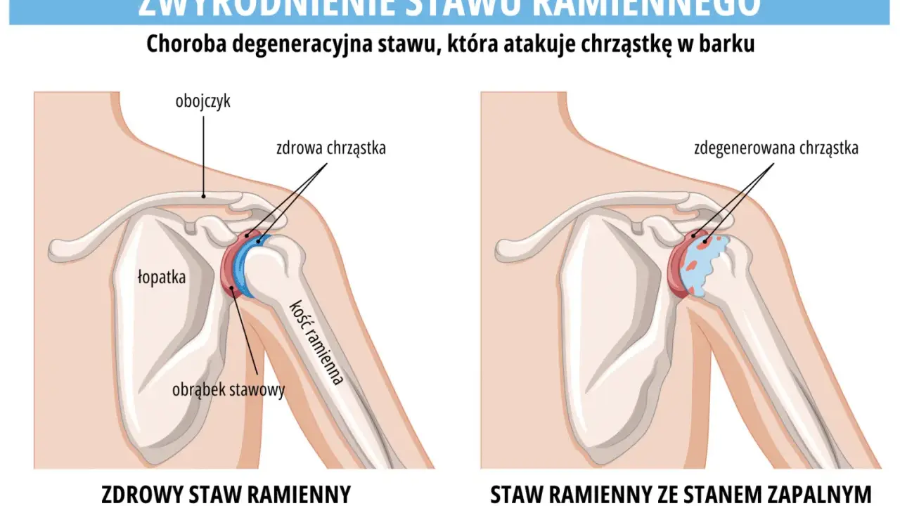 Porównanie zdrowego stawu ramiennego z tym dotkniętym chorobą zwyrodnieniową stawów, gdzie chrząstka jest zniszczona.
