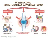 Wczesne objawy reumatoidalnego zapalenia stawów: sztywność stawu, opuchlizna, zmęczenie, gorączka, utrata apetytu.