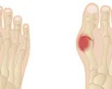 Porównanie anatomii stopy zdrowej i z haluksem, z zaznaczonym bólem.