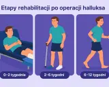 Etapy rehabilitacji po operacji haluksa: odpoczynek (0-2 tyg.), chodzenie o kulach (2-6 tyg.), powrót do aktywności (6-12 tyg.).