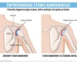 Porównanie zdrowego stawu ramiennego z tym dotkniętym chorobą zwyrodnieniową stawów, gdzie chrząstka jest zniszczona.