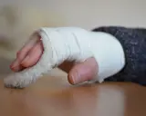 Złamany nadgarstek w bandażu. Czas rehabilitacji po złamaniu nadgarstka jest kluczowy dla powrotu do sprawności.