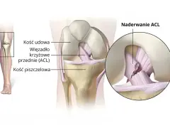 Naderwane więzadło krzyżowe przednie (ACL) w kolanie. Ilustracja pokazuje anatomię stawu kolanowego i uszkodzenie ACL.