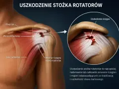 Anatomia barku z zaznaczonym uszkodzeniem stożka rotatorów. Widoczne naderwanie ścięgien mięśni stabilizujących staw.