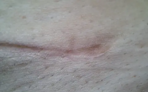 Zbliżenie na bliznę na skórze, pokazującą wczesne etapy gojenia rany. Skóra jest lekko zaczerwieniona i lekko uniesiona.