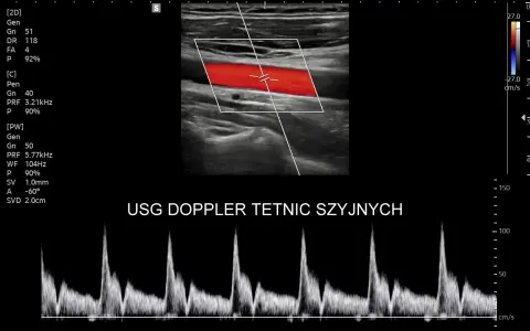 Obraz przedstawia badanie USG doppler tętnic szyjnych z widocznym przepływem krwi w czerwonych i niebieskich barwach oraz wykresem prędkości.