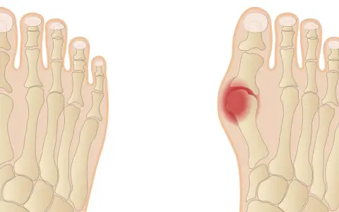 Porównanie anatomii stopy zdrowej i z haluksem, z zaznaczonym bólem.