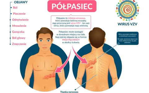 Objawy półpaśca: ból, pieczenie, gorączka. Jak złagodzić ból przy półpaścu? Infekcja wirusem VZV powoduje bolesną wysypkę.