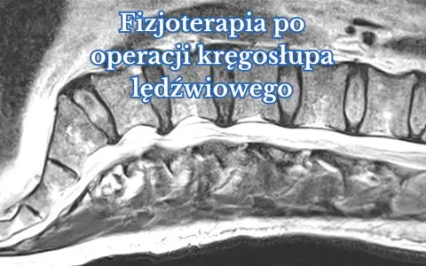 Obraz rezonansu magnetycznego kręgosłupa lędźwiowego, ilustrujący proces rehabilitacji po operacji.