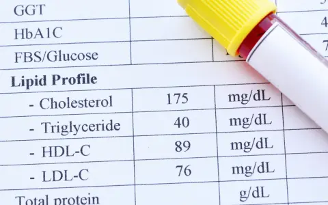 Wyniki lipidogramu: cholesterol 175, trójglicerydy 40, HDL-C 89, LDL-C 76 mg/dL.