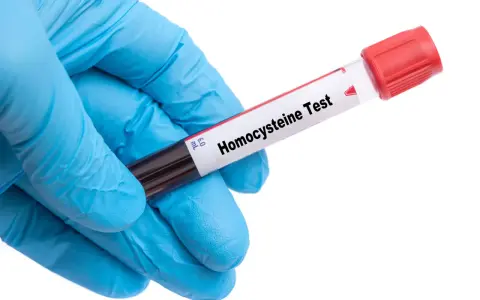 Rękawiczka w kolorze niebieskim trzyma probówkę z krwią do badania homocysteiny. Co to za badanie?