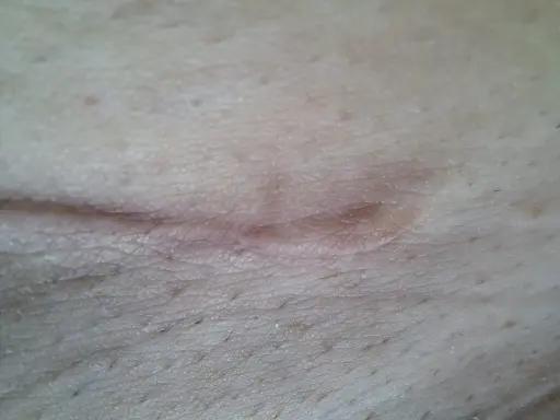 Zbliżenie na bliznę na skórze, pokazującą wczesne etapy gojenia rany. Skóra jest lekko zaczerwieniona i lekko uniesiona.