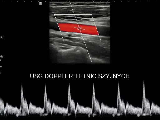 Obraz przedstawia badanie USG doppler tętnic szyjnych z widocznym przepływem krwi w czerwonych i niebieskich barwach oraz wykresem prędkości.