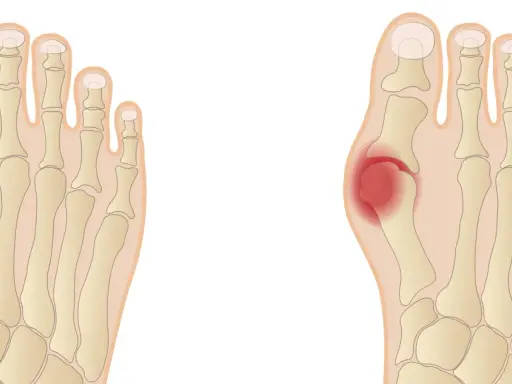 Porównanie anatomii stopy zdrowej i z haluksem, z zaznaczonym bólem.