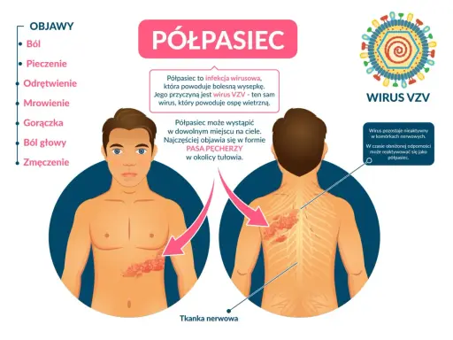 Objawy półpaśca: ból, pieczenie, gorączka. Jak złagodzić ból przy półpaścu? Infekcja wirusem VZV powoduje bolesną wysypkę.