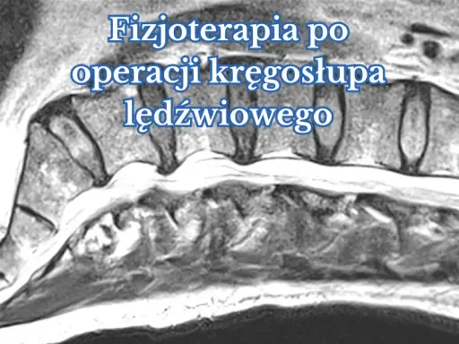 Obraz rezonansu magnetycznego kręgosłupa lędźwiowego, ilustrujący proces rehabilitacji po operacji.