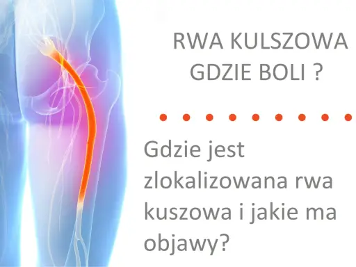 Ból kręgosłupa lędźwiowego promieniujący do nóg - rwa kulszowa. Ilustracja pokazuje przebieg nerwu kulszowego.