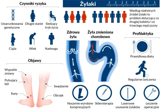 Grafika przedstawia żylaki, ich objawy, czynniki ryzyka (genetyka, siedzący tryb życia, ciąża, wiek, nadwaga) oraz metody leczenia i profilaktyki.