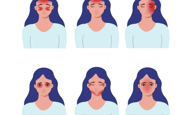 Ilustracja sześciu kobiet z różnymi obszarami bólu głowy zaznaczonymi na czerwono.