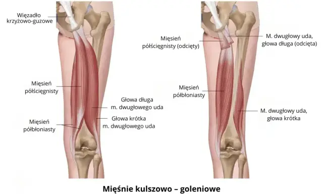 Anatomia mięśni kulszowo-goleniowych, które mogą powodować ból mięśni. Widoczne więzadło krzyżowo-guzowe i mięśnie: półścięgnisty i półbłoniasty.