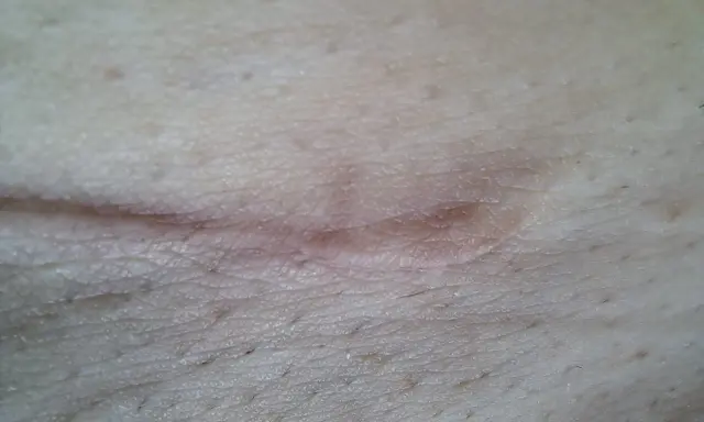Zbliżenie na bliznę na skórze, pokazującą wczesne etapy gojenia rany. Skóra jest lekko zaczerwieniona i lekko uniesiona.