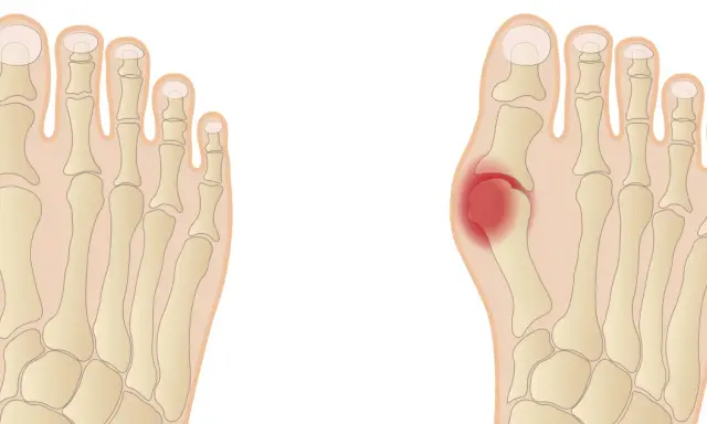 Porównanie anatomii stopy zdrowej i z haluksem, z zaznaczonym bólem.
