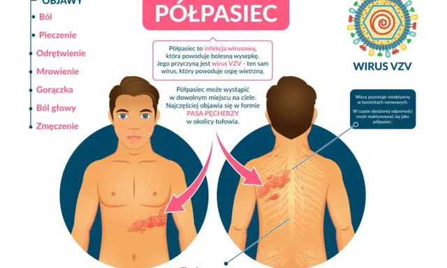Objawy półpaśca: ból, pieczenie, gorączka. Jak złagodzić ból przy półpaścu? Infekcja wirusem VZV powoduje bolesną wysypkę.