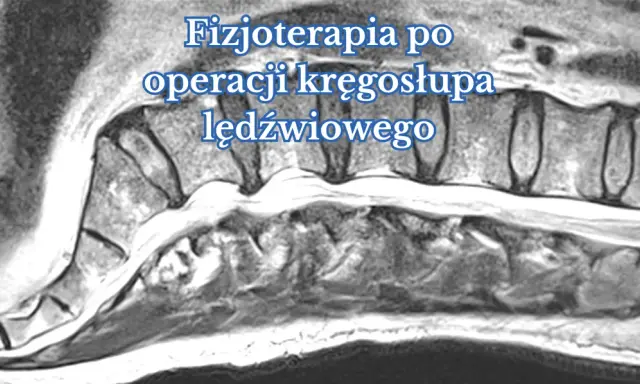 Obraz rezonansu magnetycznego kręgosłupa lędźwiowego, ilustrujący proces rehabilitacji po operacji.