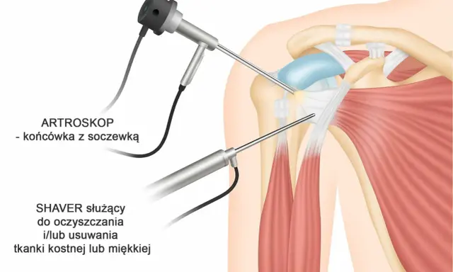 Artroskopia barku: artroskop i shaver w działaniu. Pomoc w leczeniu bólu barku promieniującego do ręki i szyi.