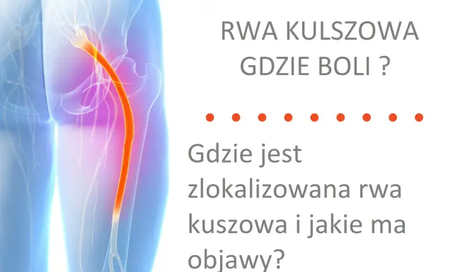 Ból kręgosłupa lędźwiowego promieniujący do nóg - rwa kulszowa. Ilustracja pokazuje przebieg nerwu kulszowego.