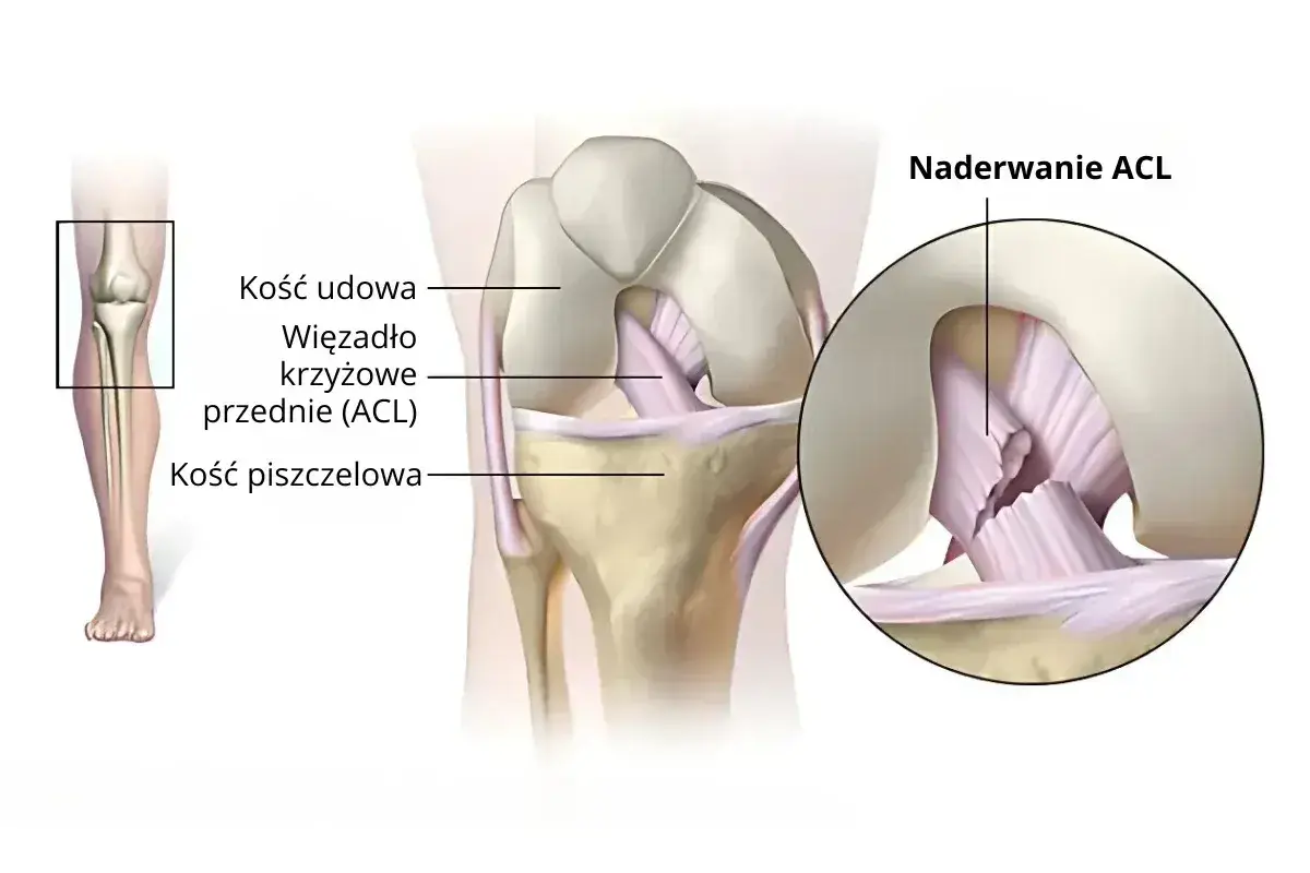 Naderwane więzadło krzyżowe przednie (ACL) w kolanie. Ilustracja pokazuje anatomię stawu kolanowego i uszkodzenie ACL.