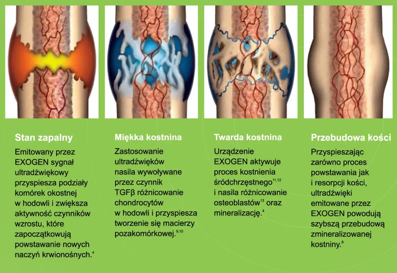 Ilustracja przedstawia etapy gojenia złamania kości: stan zapalny, tworzenie kostniny miękkiej i twardej, przebudowę kości. Długość rehabilitacji po złamaniu zależy od tych etapów.