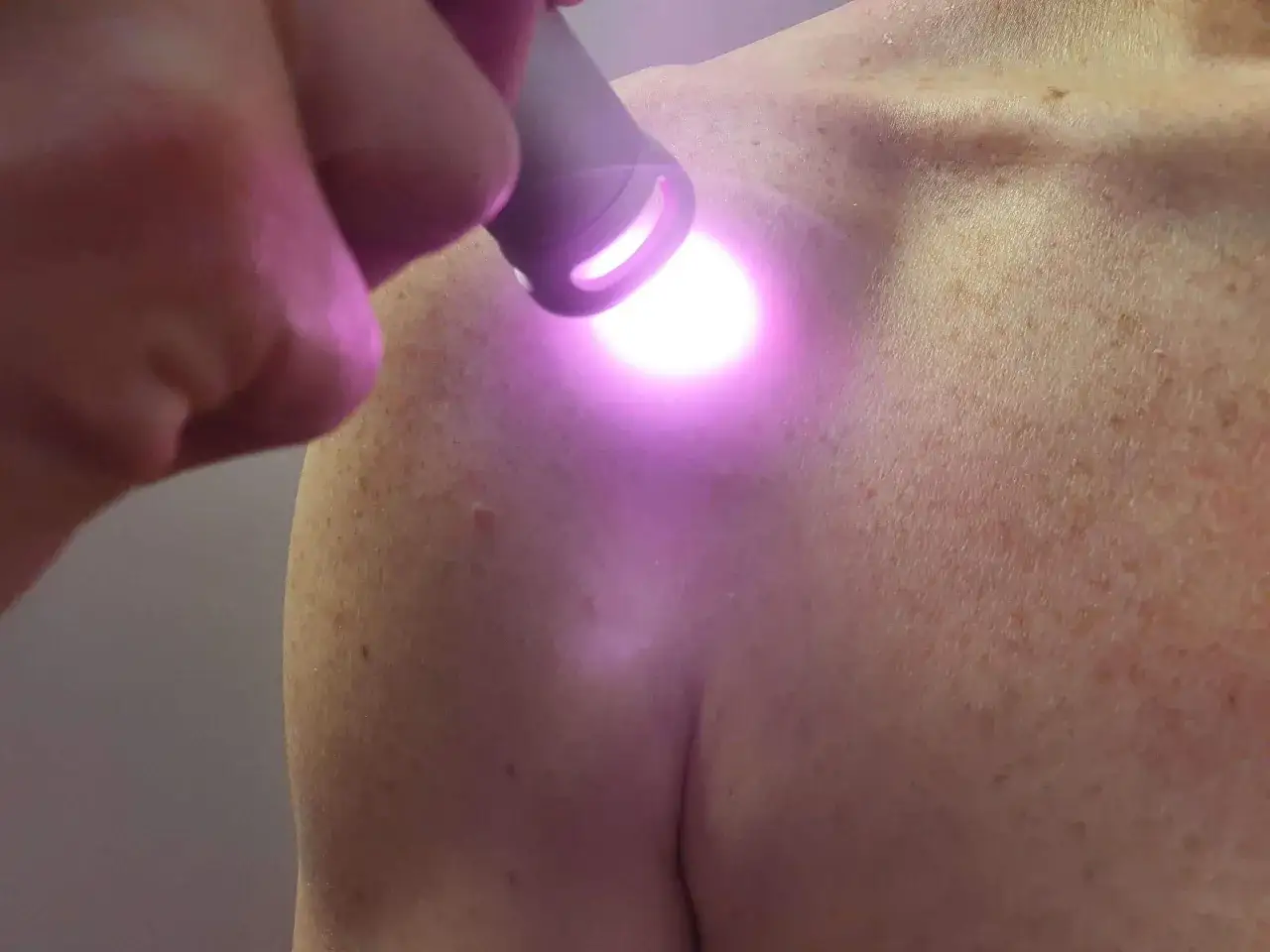 Dłoń trzyma urządzenie emitujące fioletowe światło na ramię pacjenta, pokazując, jak działa laser w rehabilitacji.