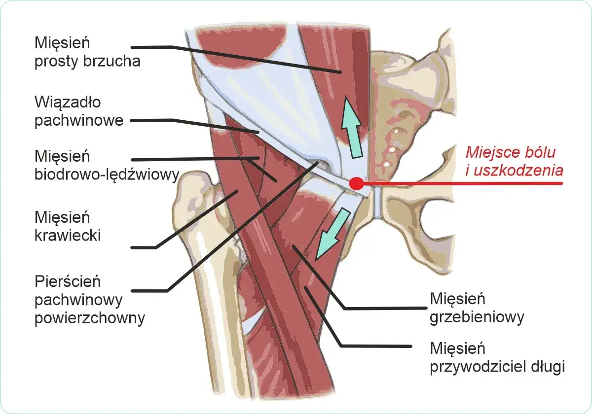 Anatomia pachwiny z zaznaczonym miejscem bólu i uszkodzenia. Widoczne mięśnie brzucha, biodrowo-lędźwiowy, przywodziciele i więzadło pachwinowe.