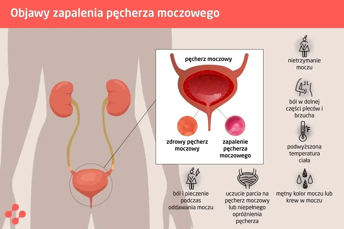 Ilustracja przedstawia objawy zapalenia pęcherza moczowego, takie jak ból, pieczenie, nietrzymanie moczu i gorączka. Wskazuje na potrzebę leczenia.