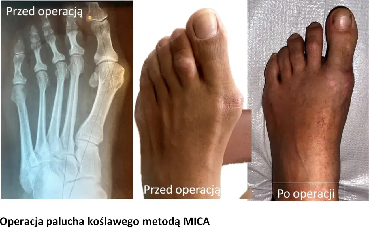 Rentgen stopy przed i zdjęcie po operacji haluksów. Pokazuje, czy warto operować haluksy, prezentując efekt metody MICA.
