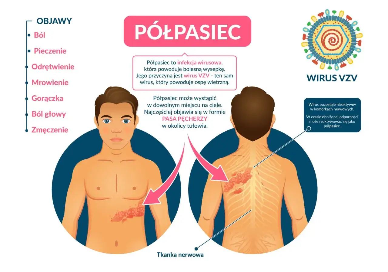 Objawy półpaśca: ból, pieczenie, odrętwienie, mrowienie, gorączka, ból głowy, zmęczenie. Jak złagodzić ból przy półpaścu? Półpasiec to wirus VZV.