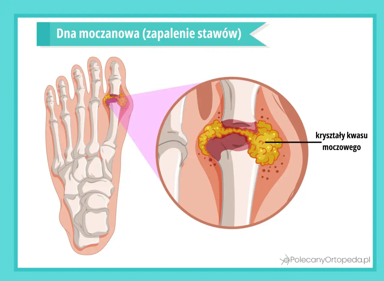 Dna moczanowa (zapalenie stawów) - kryształy kwasu moczowego w stawie palucha. Skuteczne leczenie jest kluczowe.