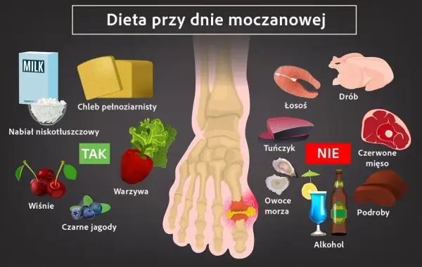 Dieta przy dnie moczanowej: nabiał, chleb, warzywa, owoce (TAK); ryby, drób, czerwone mięso, podroby, alkohol (NIE).