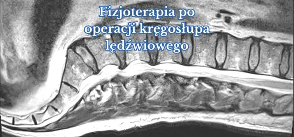 Obraz rezonansu magnetycznego kręgosłupa lędźwiowego, ilustrujący proces rehabilitacji po operacji.