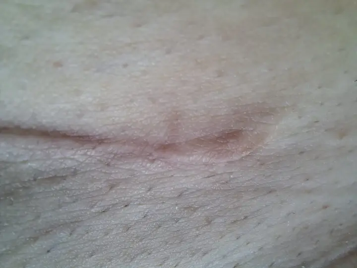 Zbliżenie na bliznę na skórze, pokazującą wczesne etapy gojenia rany. Skóra jest lekko zaczerwieniona i lekko uniesiona.