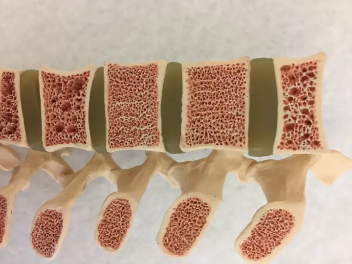 Model kręgosłupa z widocznymi przekrojami kości. Gąbczasta struktura kości sugeruje osteoporozę, czyniąc je kruchymi.