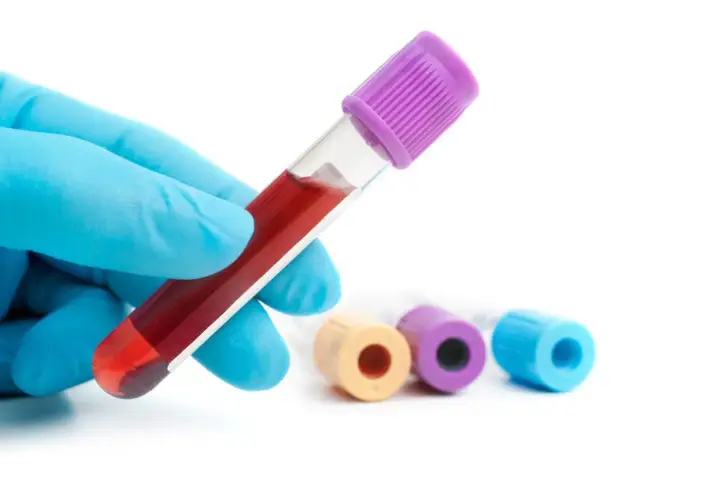 Ręka w niebieskiej rękawiczce trzyma probówkę z krwią do badania poziomu glukozy, np. hba1c.