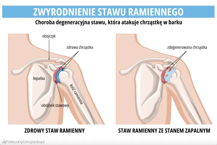 Porównanie zdrowego stawu ramiennego z tym dotkniętym chorobą zwyrodnieniową stawów, gdzie chrząstka jest zniszczona.