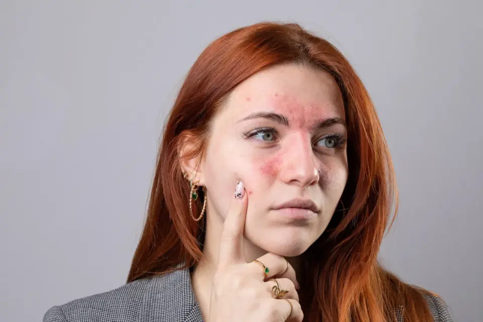 Ruda kobieta z zaczerwienioną twarzą, dotknięta toczniem. Ile się żyje z taką chorobą?